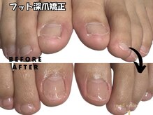 プラスワン(+1)の雰囲気（ついついむしってしまう...足を出す時期にフット深爪矯正[池袋]）