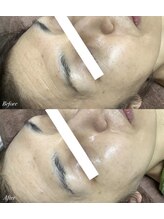 エミルカ 仙台(EMILUCA)/陶肌トリートメント