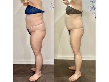 カルナ(CARNA)/【痩身】セルライトゼロ2