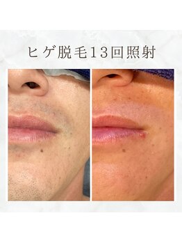 ボゴス(BOGOSS)/ヒゲ13回照射