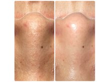 アウラ(Aula)の雰囲気（水素の力で毛穴の奥から汚れを吸引毛穴洗浄）