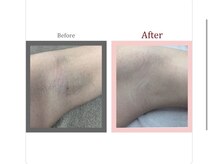 ビプラス(VIPLAS)/脇脱毛