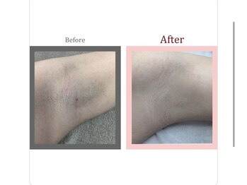 ビプラス(VIPLAS)/脇脱毛