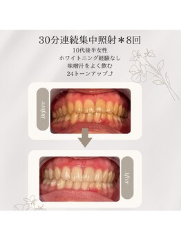 プラスビーセルフ(+b self)/ホワイトニングビフォーアフター