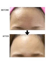 シンシア(sincere)/おでこのシワ/年齢肌/たるみ改善