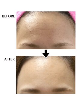 シンシア(sincere)/おでこのシワ/年齢肌/たるみ改善