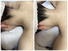 ルルトウキョウ 池袋店(LULU.tokyo)/うなじ脱毛