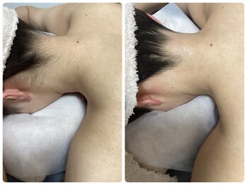 ルルトウキョウ 池袋店(LULU.tokyo)/うなじ脱毛