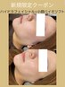 《毛穴洗浄×筋膜リフト》ハイドラ＋小顔バイオリフト¥13000