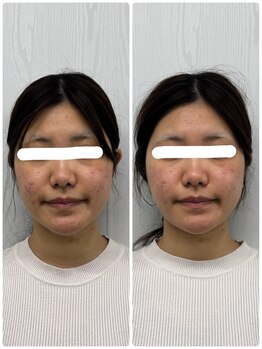 ラフテル鍼灸整骨院/肌荒れ/ニキビケアに美容鍼！