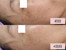 厚塗りファンデを卒業したい方には当サロンの本気のシミケア！