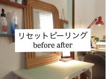 ニコラフ(Nico laugh)/リセットピーリング