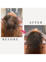 レメディ/グロスファクター育毛促進鍼