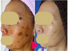 アイビューティーセンター/お顔シミ、首ポツポツ,美肌改善