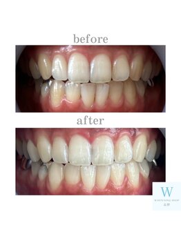 ホワイトニングショップ 長野店/サイドのお色が気になる方も♪