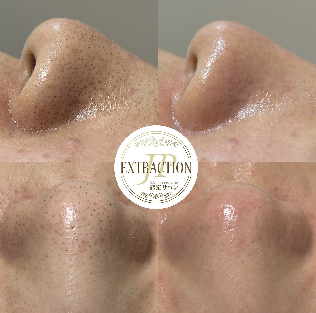 【黒ずみ・詰まり】毛穴洗浄★毛穴エクストラクション \8,000 ※平日\7,500