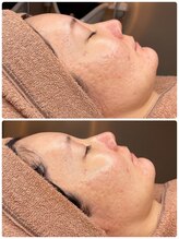 アロハーブ/ララピール