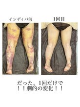 インディバケアプラチナム 横浜店/インディバ施術