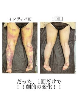 インディバケアプラチナム 横浜店/インディバ施術