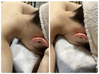 ルルトウキョウ 池袋店(LULU.tokyo)/うなじ脱毛