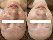 アエオボンヌール(A.E.O BONHEUR)/ハーブピーリング4回