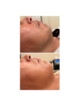 ビネージュ/メンズ脱毛