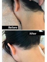 カエラ(KAELA)/うなじ脱毛7回目