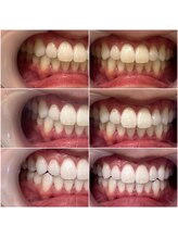 ホワイトニングショップ 静岡店/プレミアムホワイトニング経過！