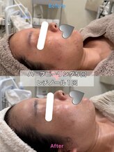 ルポアン(Repos an)/ハーブピーリング　before after