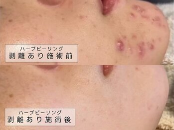 育肌美研 自由が丘サロン/ニキビケア|ハーブピーリング