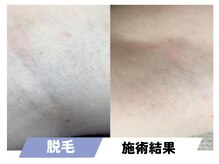 セルフィッシュビューティー/脱毛／施術結果