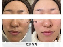 シャルトルズ 広島八丁堀店の雰囲気（幹細胞入ハーブピーリングが人気！短期間で改善！ウルツヤ韓国肌）
