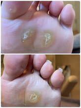 ココン フワット(cocon fouato)/足指矯正　タコなくなりました！