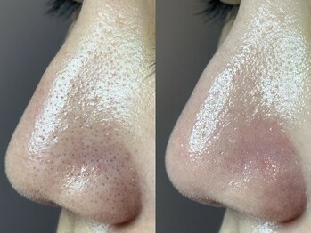 エミュ(emu)/毛穴の黒ずみ無かったことに♪