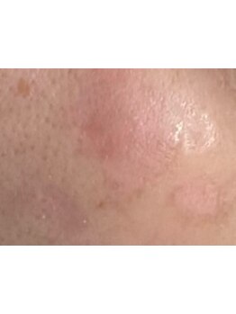 シミしわ改善！予防ケア