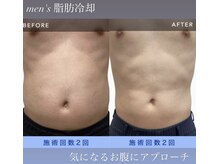 シュシュ(chouchou)/男性、脂肪冷却