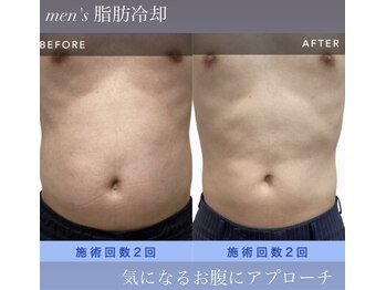 シュシュ(chouchou)/男性、脂肪冷却