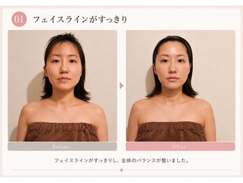 モアフェイス 池袋店(More Face)/フェイスラインがスッキリ　