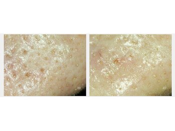 サロン ド ボーテ プルーラ(Salon de beaute PLURA)/本気の毛穴ケアでツルツル!