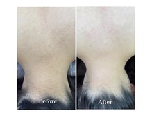 ナナイロサロン ニコリー(NaNairo nicolly)/【背中光脱毛】