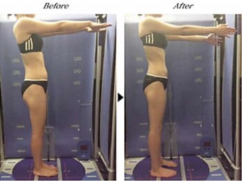 ビューティークリニックコダマ 宮崎本店/【1か月コース】M.S様（25歳）