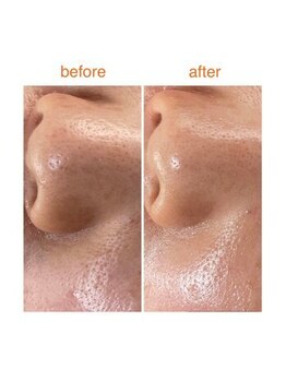 ラレコルト/ビフォーアフター