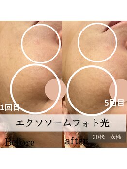 パルティノ 高崎店/5回目症例・40代・毛穴・小じわ