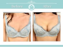 美人バスト 千早店/バストアップ◇育乳症例◇
