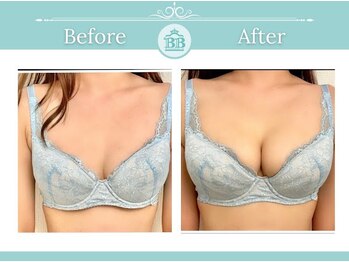 美人バスト 千早店/バストアップ◇育乳症例◇