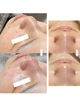 クレヴィー(Creviy)/韓国式3D毛穴洗浄＆REVlハーブ