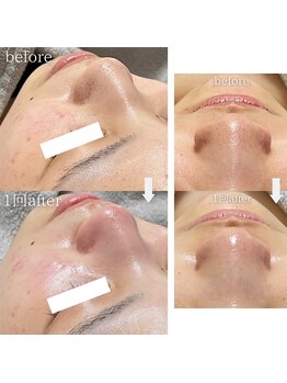 クレヴィー(Creviy)/韓国式3D毛穴洗浄&REVlハーブ