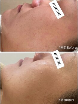 ムム(mumu)/肌の水分量UP 顎周りすっきり