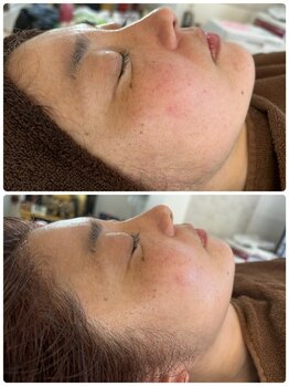 サロン ド グランツィア(salon de Granzia)/40代女性☆しみ、しわ、たるみ