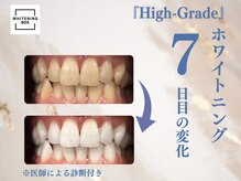 ホワイトニングボックス 豊川店/施術7回目終了後